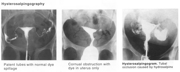 Hysterosalpingography