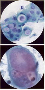 Chlamydia trachomatis: clamidia falsa y de buena fe por Chlamydia