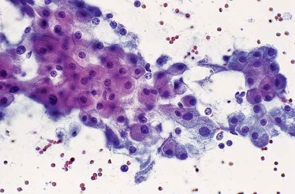 Breast Cytopathology Libre Pathology