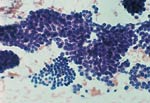 Cytologic features of various types of breast lesions as seen in FNA specimens