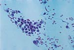 Cytologic features of various types of breast lesions as seen in FNA specimens