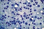 Cytologic features of various types of breast lesions as seen in FNA specimens