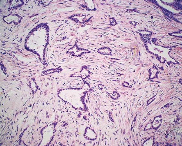 tubular carcinoma breast