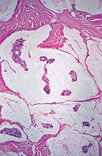 Mucinous carcinoma of the breast.