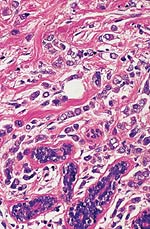 Invasive lobular carcinoma.