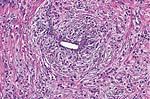 Typical target-like growth of tumor cells around an uninvolved duct in invasive lobular carcinoma