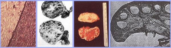 Ovaires polykystiques avec une capsule paisse et visible, des kystes sous-capsulaire. Noter l'absence de corps jaunes ou albicantia corpus en raison d'anovulation.