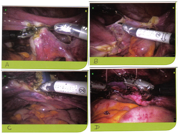 Asistida por robot histerectoma por enfermedades benignas, A. Skeletonizing pedculos vasculares y de coagulacin, B. reflexin vsico-uterino; C. Colpotoma, D. cpula vaginal cierre.