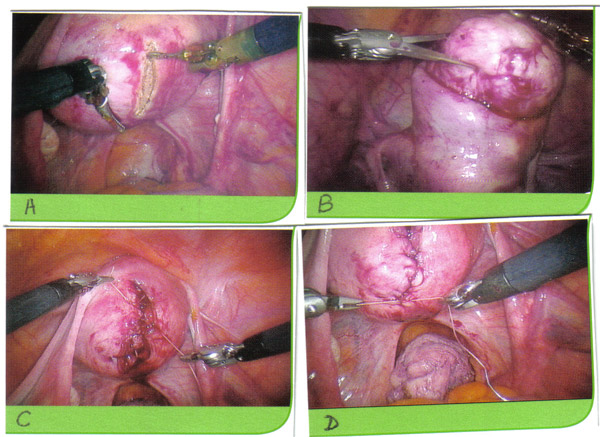 Robot-assisted myomectomy; A. Hysterotomy; B. Enucleation; C. Multi-layered suture closure of defect -- deep layers; D. Multi-layered suture closure of defect -- superficial layer.