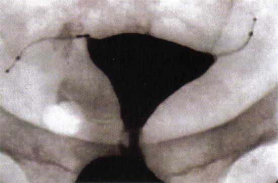 Oclusin tubrica se confirm a las 12 semanas siguientes Essure  (Conceptus, Inc., Mountain View, CA) la colocacin de microinsert por histerosalpingografa.