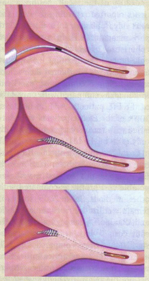 Micro-stage d'insertion. La technique Essure ® (Conceptus Inc, Mountain View, CA) procédure de contrôle des naissances permanent