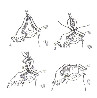 Modified Pomeroy technique of female sterilization