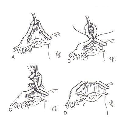 Mise  jour technique de Pomeroy de strilisation fminine