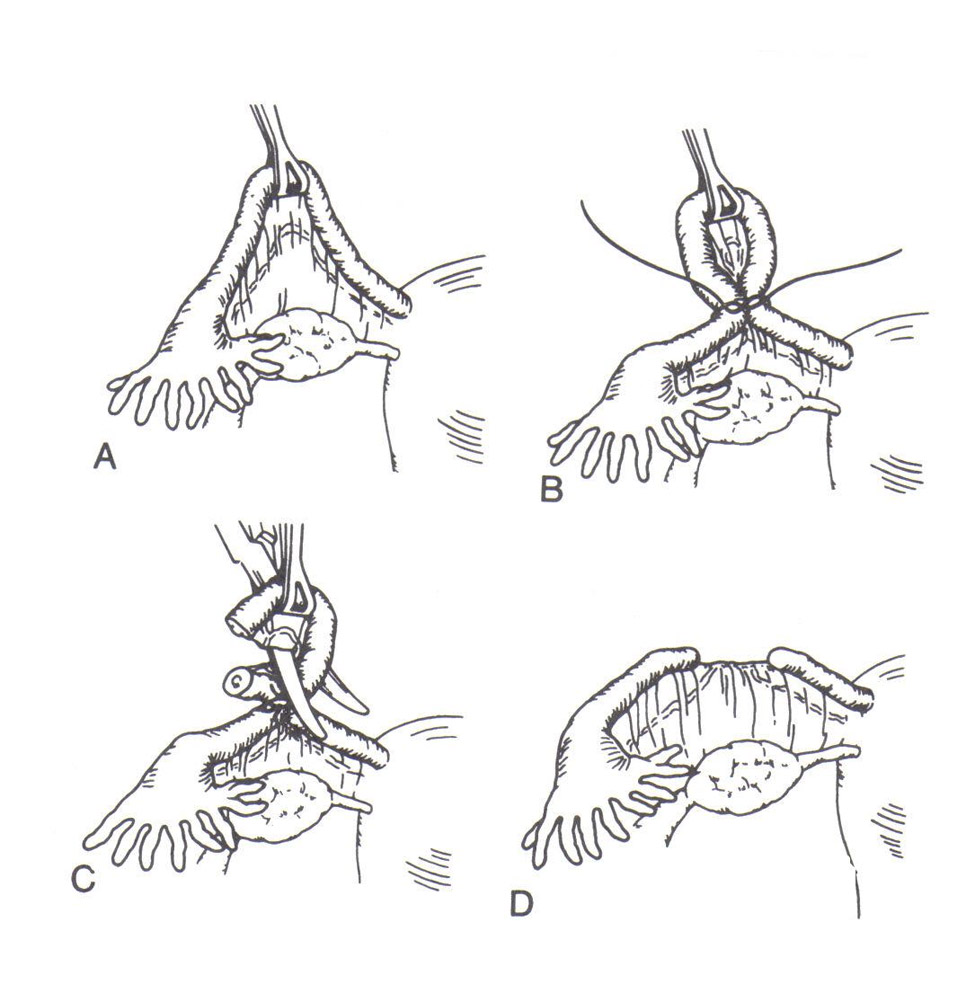 Postpartum Tubal Sterilization: Overview, Technique