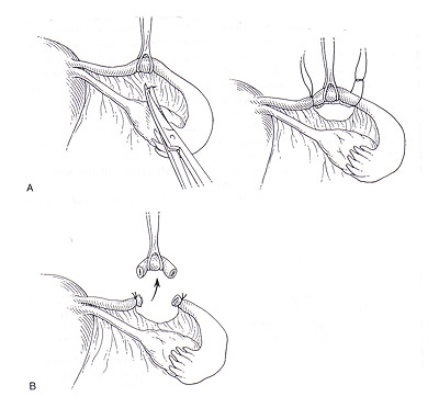 The Parkland procedure for sterilization