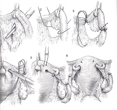 The Irving technique for sterilization