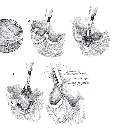 Sterilization by electrocoagulation and division via laparoscopy