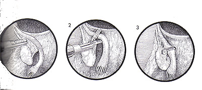 Hulka clip sterilization via laparoscopy