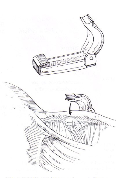 Titanium Strilisation Clip par laparoscopie