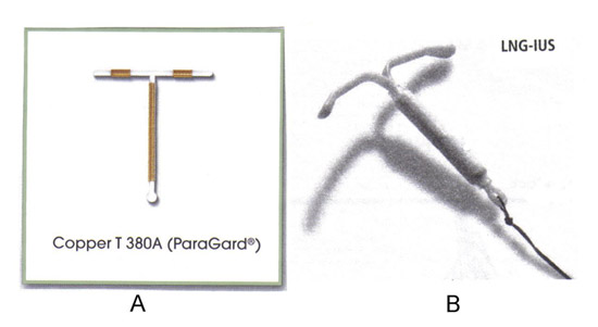 نوعين من أجهزة وسائل منع الحمل داخل الرحم وتتوفر في الولايات المتحدة. ج : والب الرحمية TCu380A ، ParaGard  ؛ باء : الليفونورغيستريل الافراج عن النظام داخل الرحم (الغاز الطبيعي المسال ، وقام الاتحاد) ، Mirena 