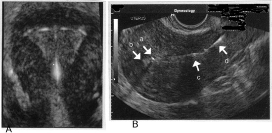 De imágenes de los dispositivos anticonceptivos intrauterinos con ecografía transvaginal. A: imagen en 3-D de la posición en el fondo adecuado de DIU, B: Con este punto de vista sagital, el componente superior del dispositivo (a) se visualiza en la proximidad de la parte del fondo del endometrio, (b) confirmar la posición adecuada del fondo de la DIU. El componente inferior del dispositivo (c) se visualiza en el segmento inferior del útero, y los hilos (d) se visualizan en la parte superior del conducto cervical.