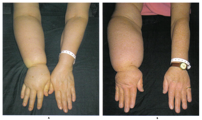 Fig. 2. A potentially irreversible form of disfiguration, lymphedema can hinder arm function and is often diagnosed too late for treatment to be effective. The women pictured above experienced arm volume increases of 31% (A) and 54% (B).