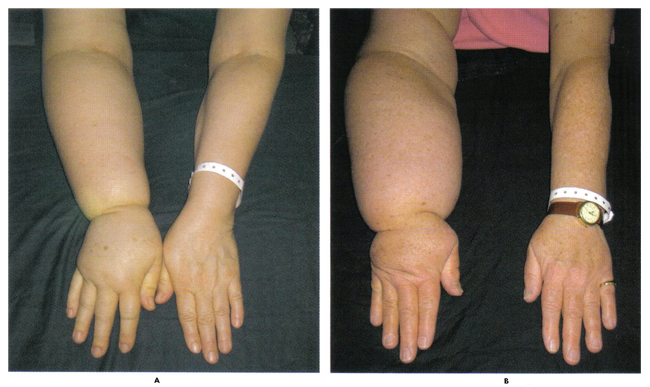 Fig. 2. Une forme potentiellement irréversible de défiguration, le lymphoedème peut entraver la fonction du bras et est souvent diagnostiqué trop tard pour que le traitement soit efficace. Les femmes ont connu des augmentations photo ci-dessus du volume du bras de 31% (A) et 54% (B).