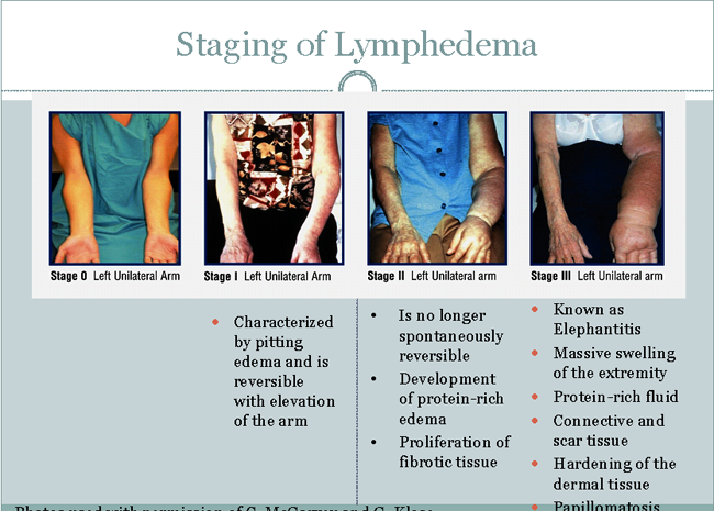 Fig. 1. Staging of Lymphedema