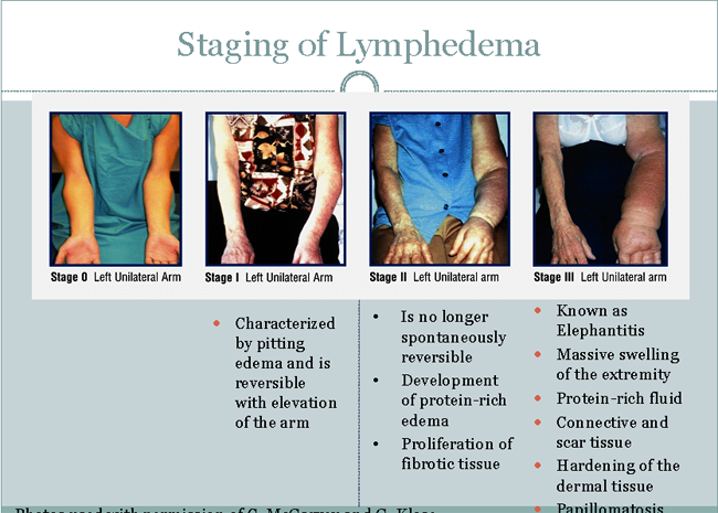 Fig. 1. Mise en scène de lymphoedème