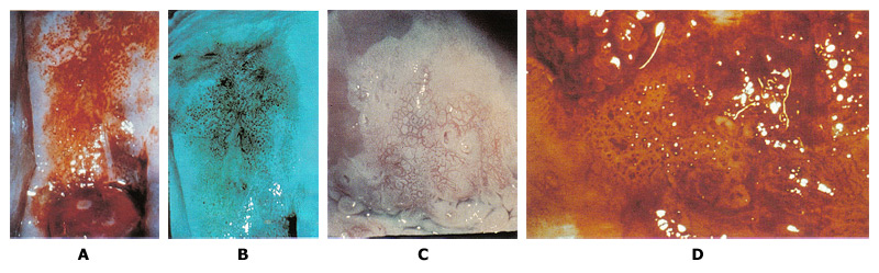 Figure 2. A. Punctation on the anterior lip of the cervix is mixed with some white epithelium. Biopsy specimen for the area showed CIN3. B. Use of green filter on the colposcope enhances the appearance of punctation. C. Mosaic pattern is seen within the white epithelium. Biopsy from the area showed carcinoma-in-situ. D. Atypical vessels. The terminal vessels are irregular in size, shape and arrangement. Biopsy specimens revealed invasive carcinoma.