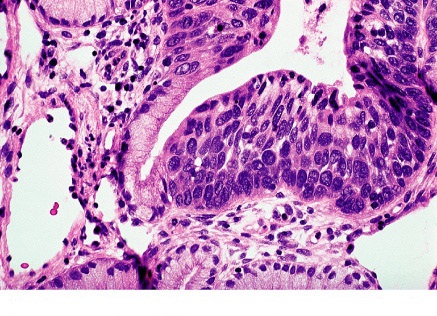 Figure 3. HSIL histology: extensive involvement by CIN3 of surface epithelium and glands of cervix.