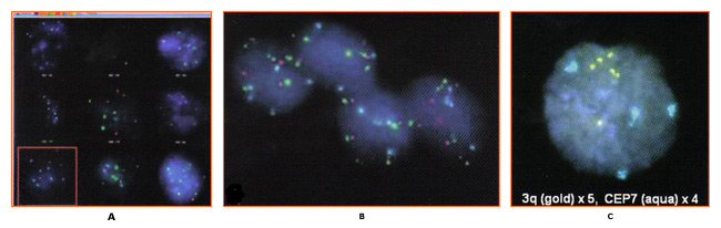 Figura 1: A. digitalizadas informacin de la clula y los datos para obtener 3q, la muestra: PESCADOS <i>oncolgica</i> de cuello uterino, B. de la clula se detectan utilizando microscopia de luz transmitida y reflejada, 3q C. Resultado positivo para 3q ganancia (ms de 2 ncleos con ganancia de> copias de ). Fotografas cortesa de Ikonisys Inc. 