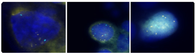 图2：第三季度荧光原位杂交（FISH）技术信号是有色金粒7鱼和控制信号的彩色<i>旱厕</i> 。全部3细胞表现出超过4年第三季度（ <i>金）的</i>鱼信号。照片提供：Ikonisys公司