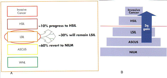 Figura 3: A. Un esquema de regresin que indica LSIL o progresin. obtener B. 3q puede ayudar en la categorizacin de los pacientes con diagnstico previo de LSIL en la estratificacin del riesgo. WNL, dentro de los lmites normales; NILM, negativo para lesin intraepitelial o malignidad. Fotografa cortesa de Ikonisys Inc.