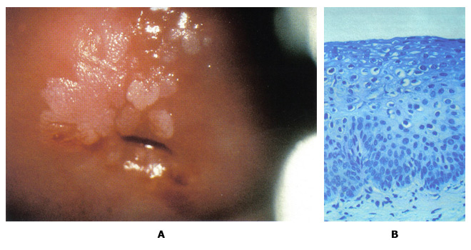 Figure 5: A. colposcopique photographie du col après l'application de l'acide acétique démontrant des lésions acidophiles nombreuses compatible avec une lésion de bas grade intra-épithéliale épidermoïde (LSIL). B. constatations histologiques montrent une perte de polarité dans le tiers inférieur de l'épithélium et koïlocytes nombreuses, conformément à la néoplasie cervicale intra-épithéliale, grade 1, avec des fonctionnalités HPV.