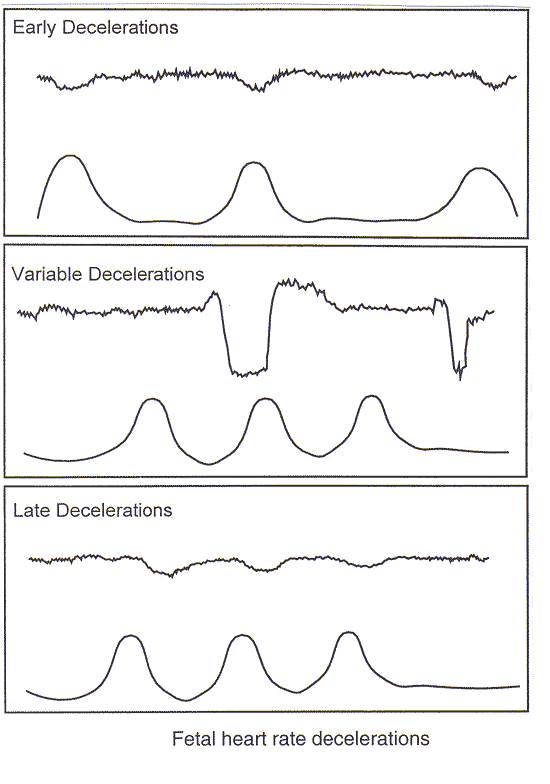 Monitoreo Fetal Monitorizaci n Fetal