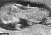 Increased nuchal translucency measurement of 3.7 mm at 12 weeks in a fetus with Down syndrome