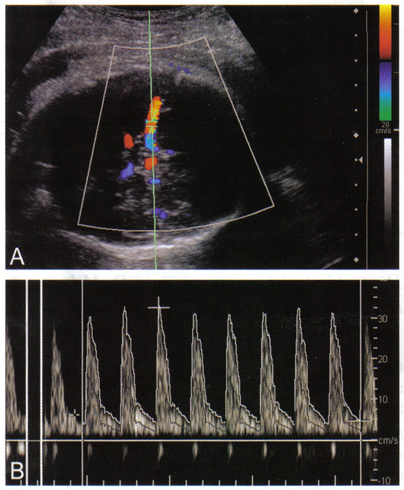 Fig. 1. A. Doppler couleur cartographie du polygone de Willis, avec le placement du curseur dans l'artère cérébrale moyenne et proximale correction de l'angle. B. Doppler forme d'onde du spectre de l'artère cérébrale moyenne chez un foetus de 30 semaines de gestation, mesure le pic de systole, la vitesse maximum de temps en moyenne, et à la fin diastole. 