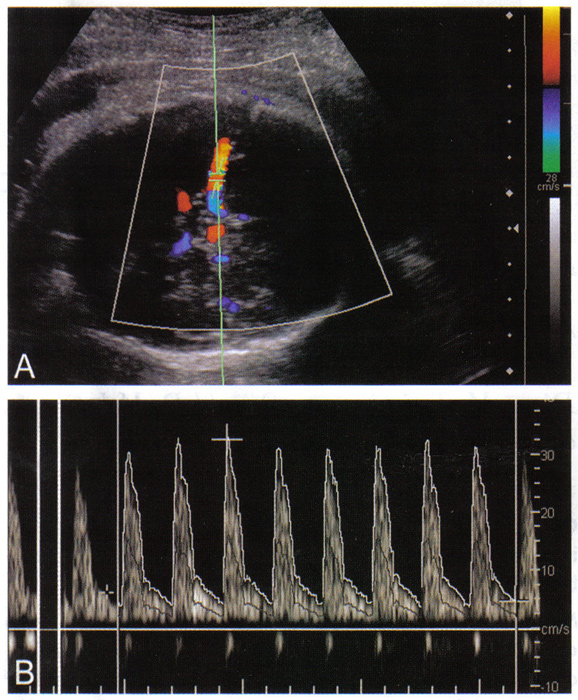 Fig. 1. A. Doppler Color asignacin del Crculo de Willis, con la colocacin del cursor en la porcin proximal de la arteria cerebral media y la correccin del ngulo. B. la forma de onda Doppler espectral de la arteria cerebral media en un feto de 30 semanas de gestacin, la medicin de pico de la sstole, la velocidad del tiempo mximo de media, y al final la distole.