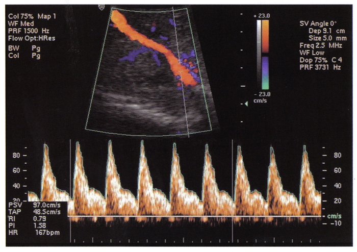 Fig. 2. The visualization of thoracic aorta and its flow velocity waveform. Pulsatility index: 1.58 indicates normal blood flow
