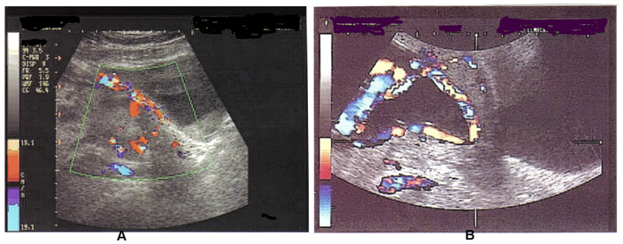 Fig. 3 A. Doppler couleur échographie du placenta accreta; B. Doppler couleur échographie du vasa praevia