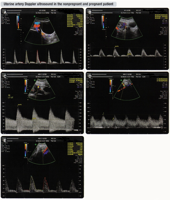 Fig. 4 A. Nonpregnant patient; B. First trimester; C. Second trimester; D. Third trimester; E. Abnormal uterine artery Doppler wave from demonstrating high resistance.