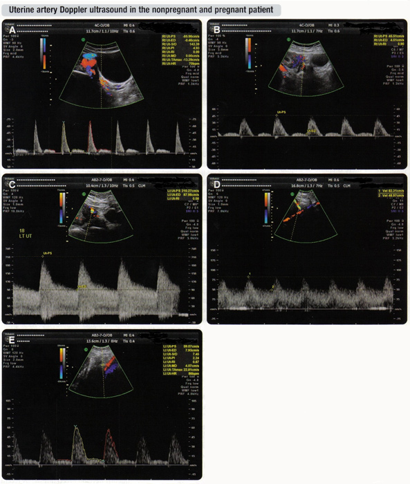 Рис. 4 А. небеременных пациентов; B. Первый триместр; С. Второй триместр; Д. Третий триместр; Е. Аномальные маточной артерии доплеровского волны от демонстрирует высокую устойчивость.