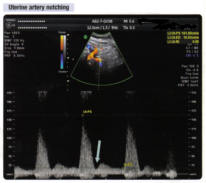 Fig. 5 Uterine artery notching