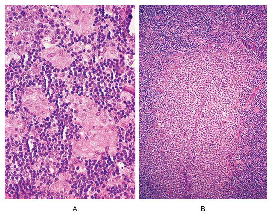 داء المقوسات من العقدة الليمفاوية. (أ) عدم الصغيرة caseating granulomas يتألف من خلايا epithelioid تقع في محيط خباء المفرطة التصنع. هذه الصورة تكاد تكون pathognomonic من هذا المرض. (ب) ومنطقة باء monocytoid ضخمة تضخم الخلايا.