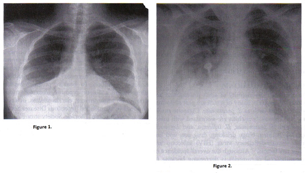 Figure 1. Chest radiograph of right pneumococcal pneumonia; Figure 2. Chest radiograph of pregnant woman with varicella pneumonia. Note the nodular and interstitial infiltrates similar to other viral pneumonias.