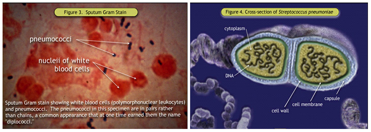Figure 3. Sputum Gram Stain; Figure 4. Cross-section of <i>Streptococcus pneumoniae</i>
