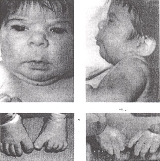Fetal hydantoin syndrome: facial features - upturned nose, mild midfacial hypoplasia, long upper lip with thin vermilion border and lower distal digital hypoplasia.