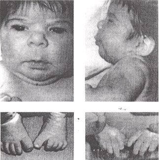 Hidantona sndrome fetal: rasgos faciales - repunte nariz, hipoplasia mediofacial suave, largo con labio superior delgado y bermelln frontera inferior distal hipoplasia digital.