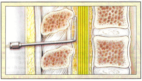 Epidural Catheter Placement dans l'espace